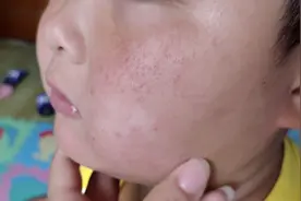 孩子脸上皮肤过敏，起了好多小红点点，改怎么办呢？视频封面