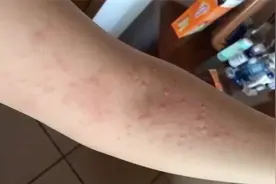 有过敏史还不忌口！准妈妈吃下20只小龙虾，致荨麻疹险失胎儿视频封面