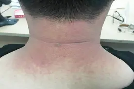 立秋后阳光依然“硬核” 不注意吃穿这种病找上门视频封面
