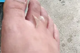 脚脱皮是正常还是有病呢？视频封面