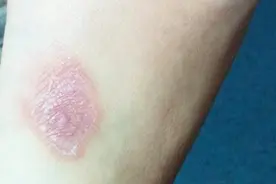 医生提醒：怀疑感染“梅毒”了，这几项检查要及时做！视频封面