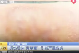 泰国进口“青草膏”网上卖得火，患者轻微烫伤后涂抹，更严重了！视频封面