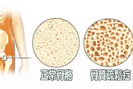 骨质疏松不会引起肩周炎，严重的骨质疏松，会引起身体多处疼痛！视频封面