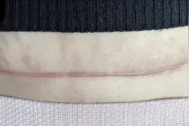 剖腹产六个多月的伤疤，不想像妹子一样难看，记住以下几点很重要视频封面