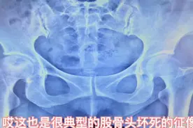股骨头坏死，严重吗？看看片子，就知道它的严重性。视频封面