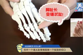 脚趾太长，穿鞋顶脚，怎样缩短？视频封面