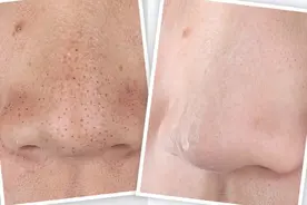 爽！黑头全部消除 毛孔缩小！最全的美容院秘密去黑头方