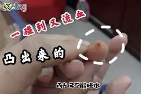 媳妇手指上长个凸出小红泡，搓破以后不能结巴，好像是血管瘤？视频封面