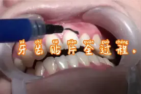 牙齿贴片的全部过程视频封面