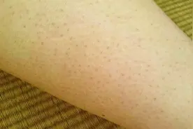 身上的鸡皮肤太难看了，教你最简单有效的去除方法，用过的都说妙视频封面