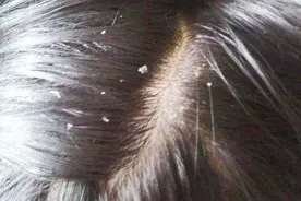 刚洗完头就有头皮屑？洗头时水里加点它，头屑去无踪，效果太厉害视频封面