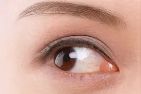 单眼斜视可以不用手术治疗？这不是斜视眼这是“缺心眼”！视频封面