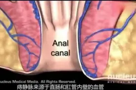外国人用动画描述痔疮的发生和治疗视频封面