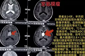 每日影像，#室管膜瘤。