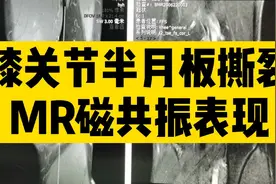 25岁小伙剧烈运动出现膝关节疼痛，MR核磁共振直接诊断半月板撕裂视频封面
