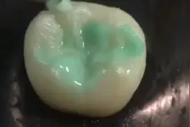 有必要给孩子做窝沟封闭吗？视频封面