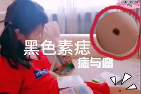 宝宝小腿长黑痣，面积变大颜色深，9岁必须做手术，啥痣这么严重视频封面