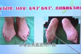 真实拇外翻病例在线讲解：畸形原因是阴阳失衡，筋出槽、骨错缝视频封面