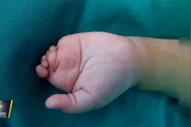 孩子先天缺手指医生用球囊扩充技术根治   医生：规范孕检不能少视频封面