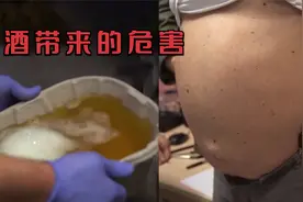 这就是长期酗酒发生的变化：肚子像孕妇，堆积的腹水都能抽2桶视频封面