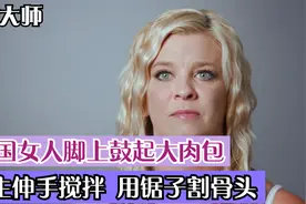 外国女人脚上鼓起肉包，医生直接伸手进去翻搅，用锯子锯掉骨头视频封面