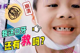 爱玩奥特曼卡牌的皮皮佑，门牙缝隙太大，牙科给孩子拍CT找到原因视频封面