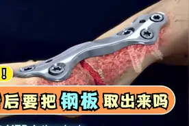 骨折植入的钢板，该取下来吗？医生耐心回答：取决于4个方面视频封面