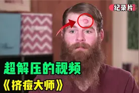 小帅额头上长了两颗囊肿，网红李医生直接双手挤痘，实在太解压了视频封面