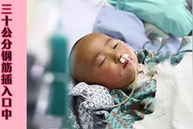 三岁孩子身陷险情，30公分钢筋插入口中，连做三次手术才保住性命视频封面