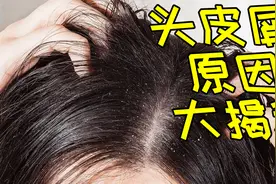 为何会有头皮屑？ 头皮屑异常增多的背后最重要的原因是？视频封面