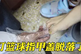 男子打篮球指甲盖和肉分离了，医生：没大问题，会长出新的指甲