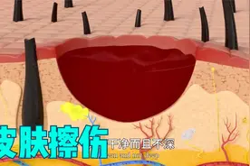 皮肤擦伤怎么好得快？医生教你如何正确处理