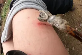 皮外伤没当会事，导致伤口处化脓，用自制的药酒清理一下挺好用视频封面