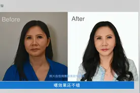 台湾阿姨面部皮肤松弛，给她设计变年轻方案，小拉皮轻松解决！视频封面