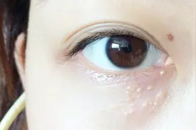 去除脂肪粒，10个人8个错，教你两招，脂肪粒去除干净还彻底视频封面