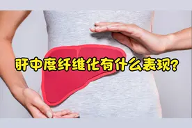 肝中度纤维化，常有这7种表现，如何杜绝纤维化，医生这样说视频封面