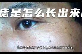痣是怎么长出来的？视频封面