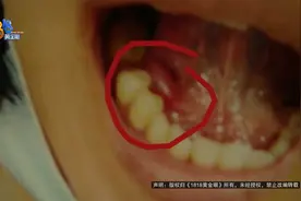 【1818黄金眼】得了“舌下腺囊肿”，想到一个月前洗牙视频封面