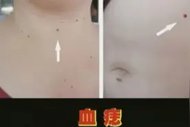 手诊面诊：黑斑淤血、白斑毒素、血痣脂肪代表什么意思？视频封面