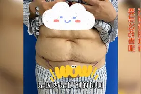 产后妈妈，以剖腹产瘢痕为界限，上下分层，出现双层肚的情况。视频封面