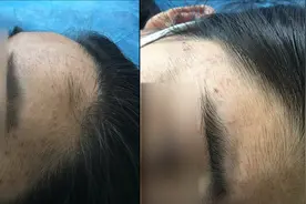 河南15岁少女1300元脱毛却越脱越多？母亲哭诉：女儿门都不敢出视频封面
