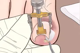 第一视角体验医生修剪全过程，帅哥的脚得了甲沟炎视频封面