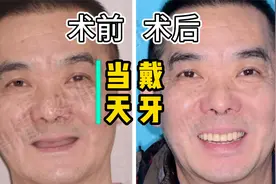 因活动假牙困扰10年的犯恶心，今天一天解决！当天恢复24颗牙！视频封面