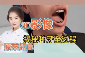 牙齿拔掉了 需要种牙 揭秘种牙的全套过程 惊叹不已视频封面