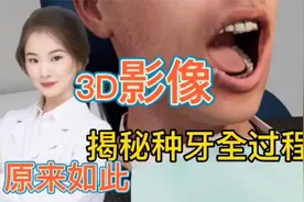 牙齿拔掉了 需要种牙 揭秘种牙的全套过程 惊叹不已视频封面