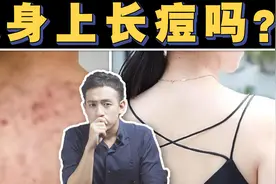 后背、下巴全是痘怎么办？I 身上的痘痘如何治疗？视频封面