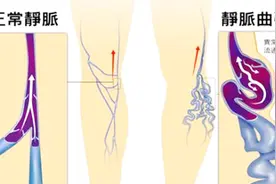 常吃这类食物，轻松解决静脉曲张，去掉腿上的“小蚯蚓”！视频封面