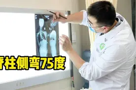 35岁女子脊柱侧弯75度，只因小时候技术不发达耽误到了现在视频封面