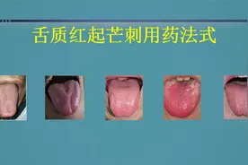 刘国轩六维舌鉴：舌质红起芒刺用药法式