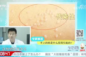 小女孩手指长肉球，被专家诊断为瘊子，这东西还传染，要小心了视频封面